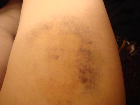 03 The bruise - good isn't it!