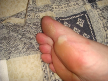 01 My feet hirt - see my blister